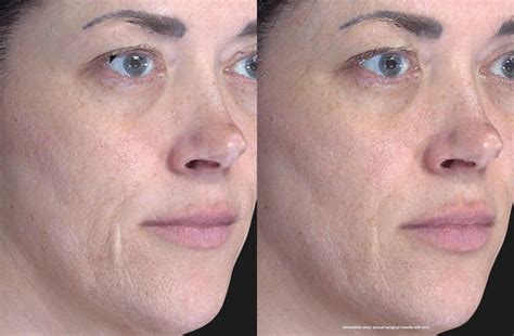 Fraxel Laser Resurfacing Treatment .